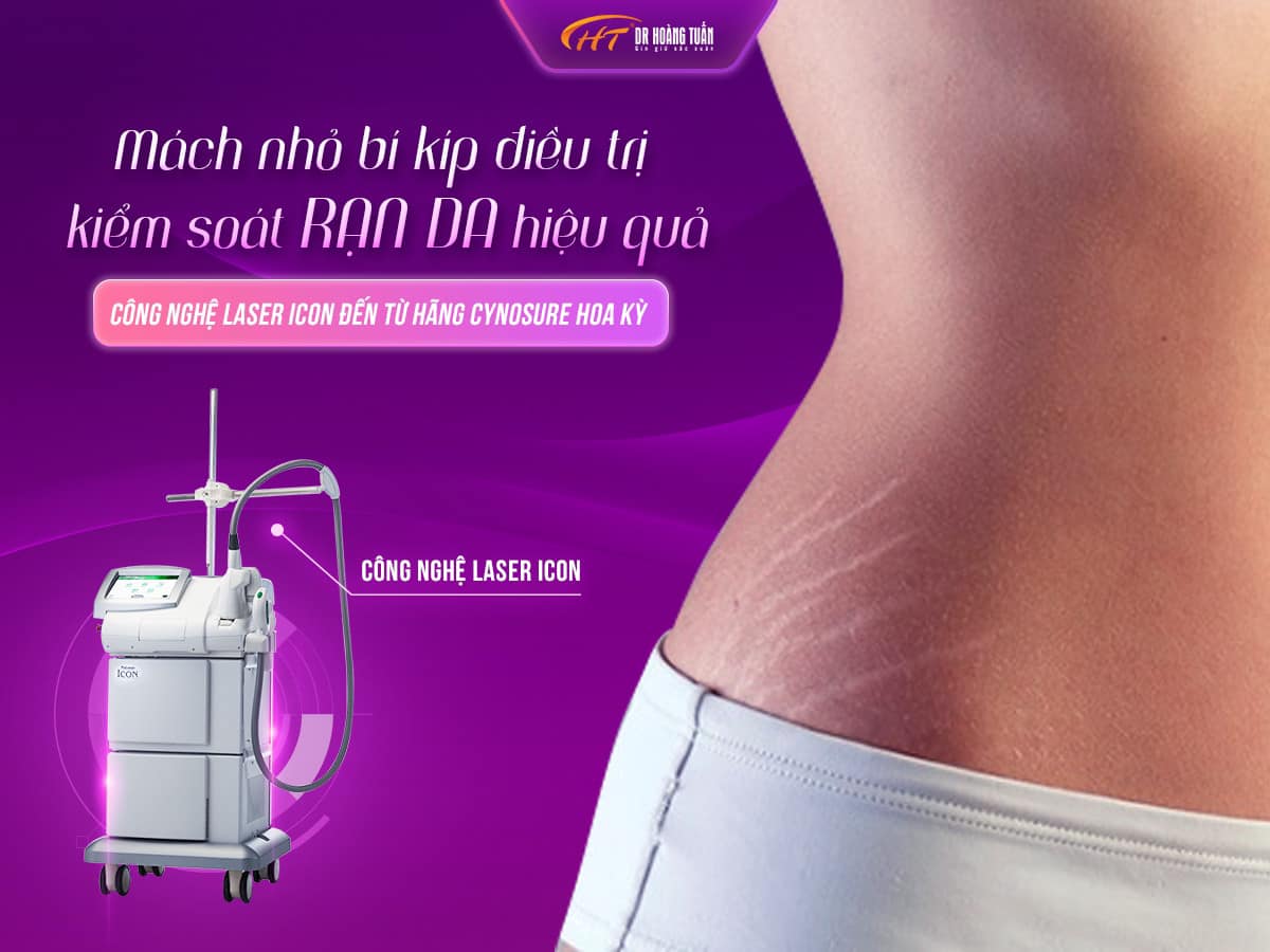 trị rạn da bằng laser trị rạn da bằng laser